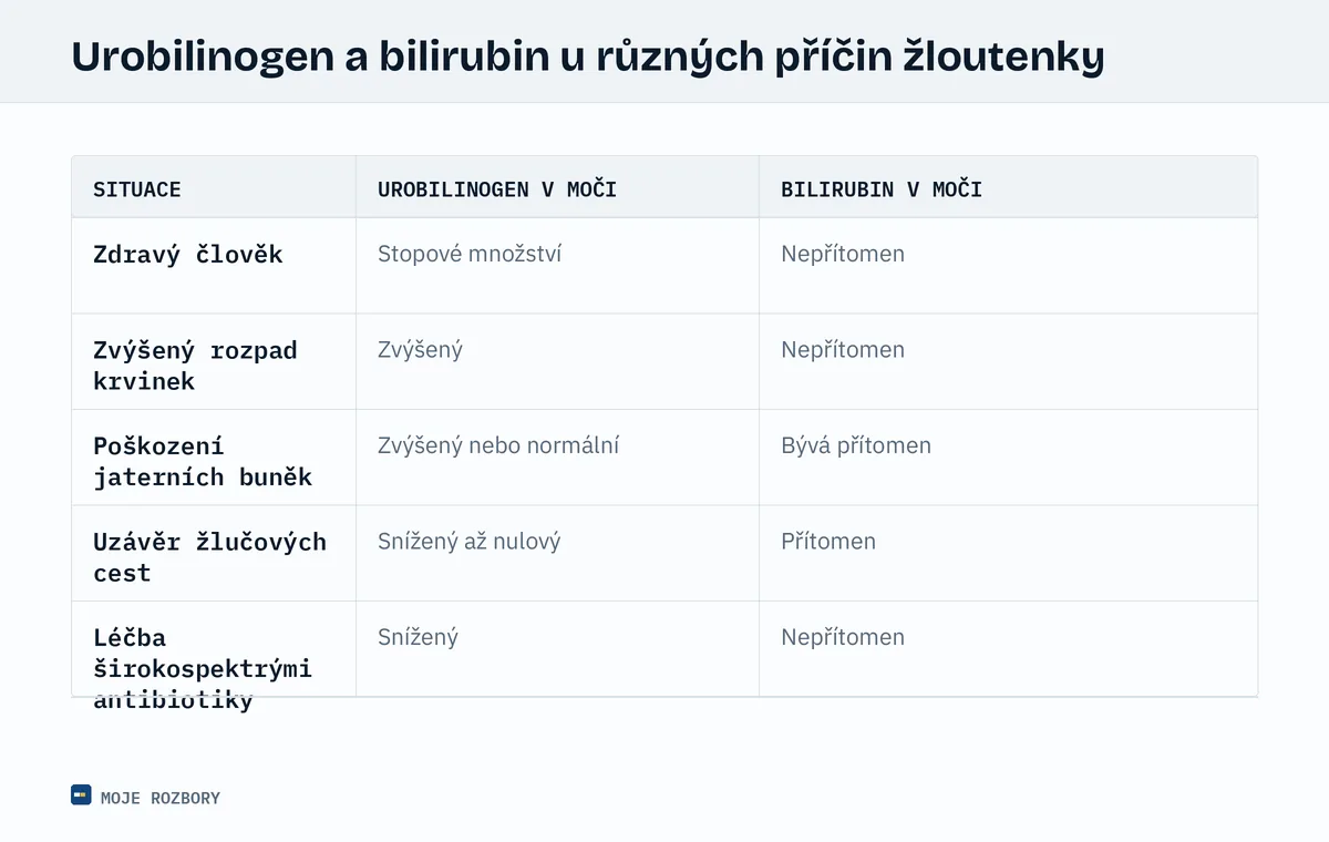 Tabulka porovnávající hodnoty urobilinogenu a bilirubinu v moči u pěti typických klinických situací